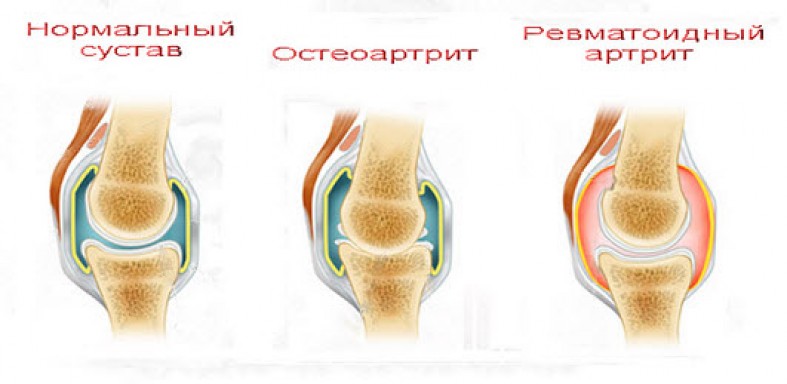 Диета при ревматоидном артрите суставов. Ревматоидный артрит суставы. Отечный сустав при ревматоидном артрите.