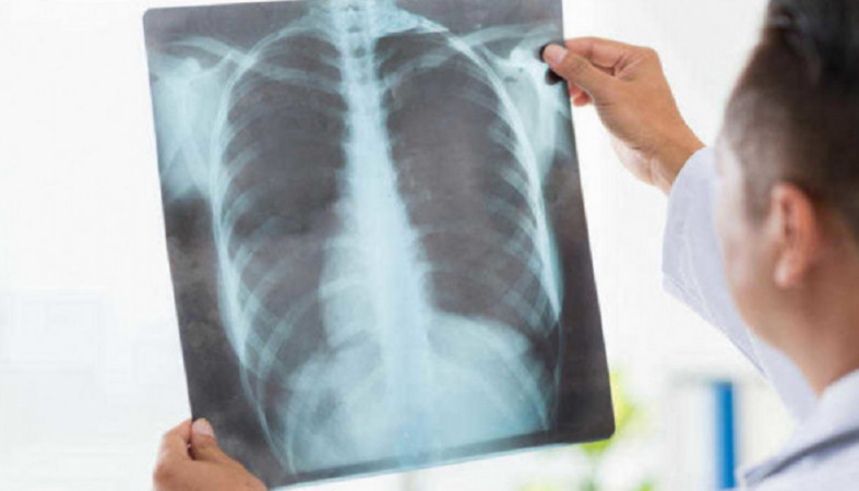 Восемь новых случаев внебольничной пневмонии диагностировано в Карелии